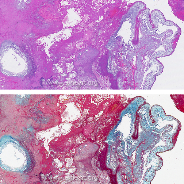 Intimal Sarcoma H&E & Movat